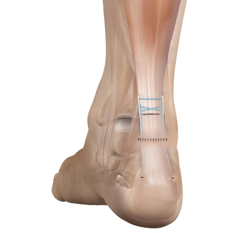 Sistema PARS Aquiles