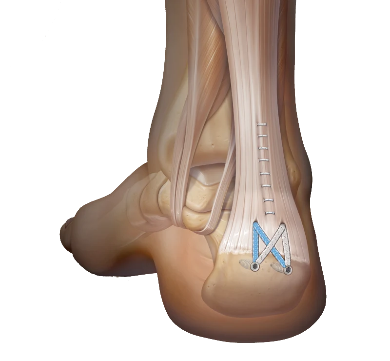 Achilles SpeedBridge
