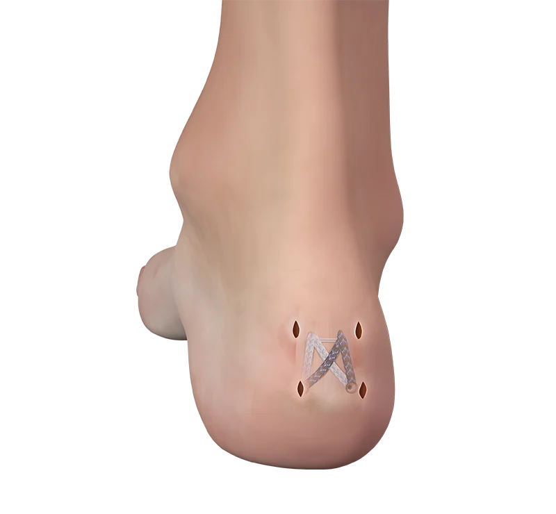 Reparación FiberTak