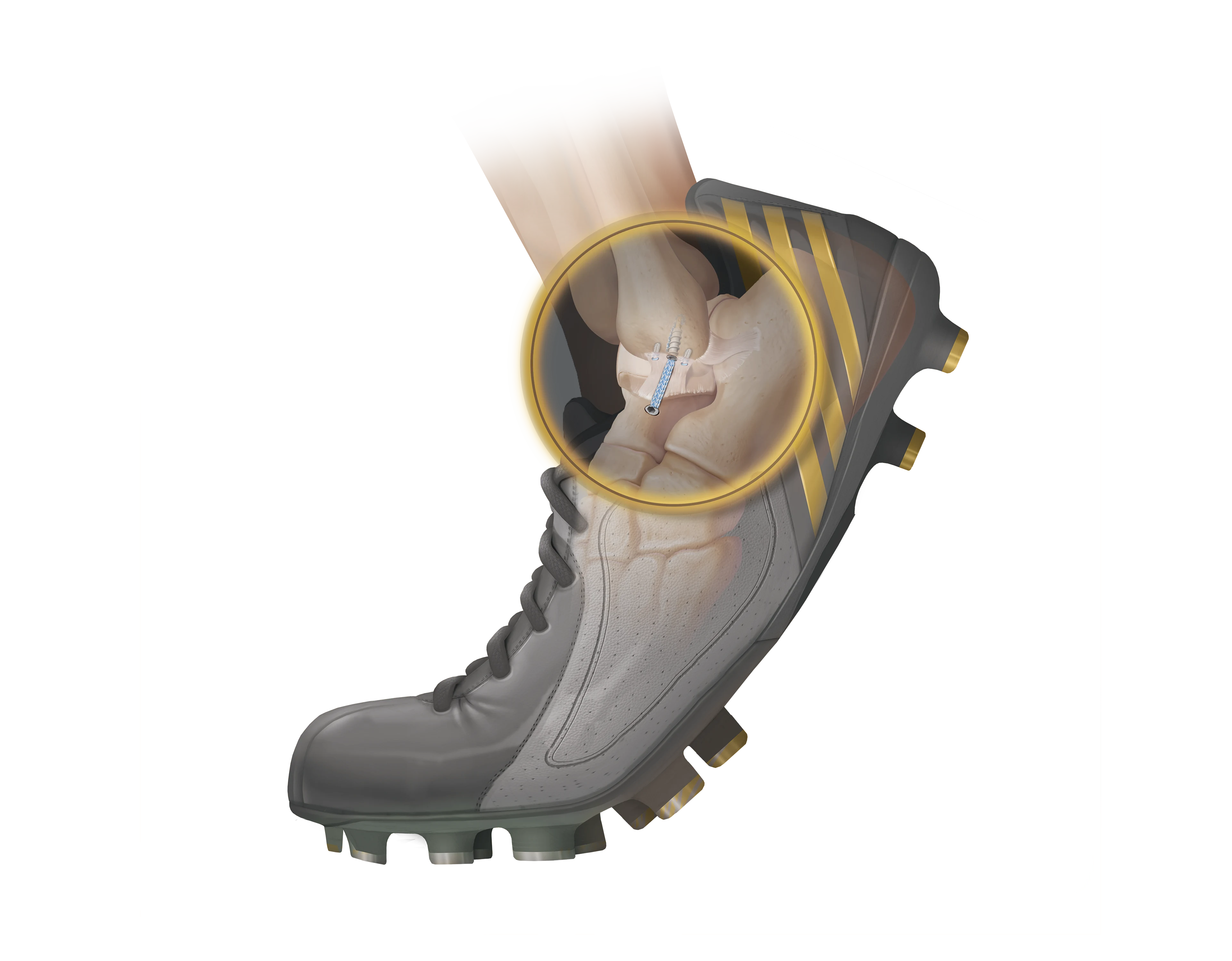 InternalBrace Tobillo