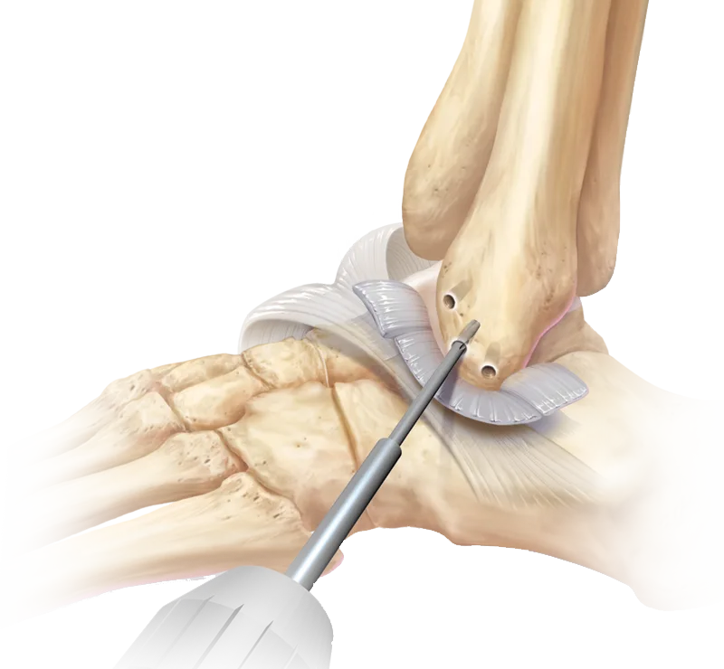 Procedimiento Brostrom