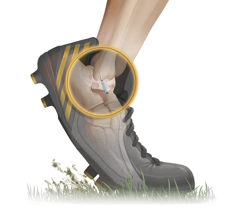 Estabilización Ligamentaria