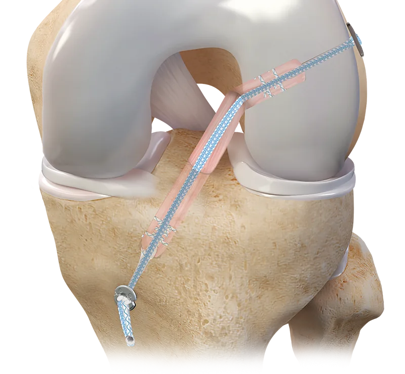 FiberStitch Meniscal Repair