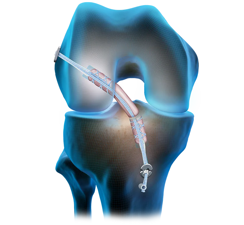 Meniscal Repair Technique